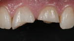 Fig 1. (Case 1) Two endodontically treated central incisors after trauma.