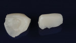 Fig 3. The mock-up sections of the restoration were
finished and polished outside the oral cavity and then cemented in place with a resin cement.