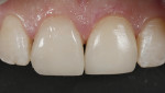 Fig 4. The cemented
restorations after finishing and polishing.