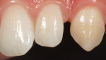 Fig 5. (Case 2) Diastema caused by a peg-shaped lateral incisor and small
canine. The patient wanted the space closed.