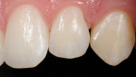 Fig 6. Restoration of the lateral incisor (tooth No. 10) with Venus Pearl
PURE, Light shade, and the canine (tooth No. 11) with Venus Pearl PURE, Medium shade.