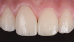 Fig 10. Tooth No. 8 was restored
using Venus Pearl PURE, Light shade, with the addition of Venus Diamond Clear Opal (CO) shade to mimic the incisal
edge of the adjacent tooth.