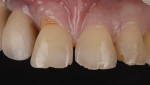 Fig 11. (Case 4) Worn dentition with shape defects and cervical abrasions.