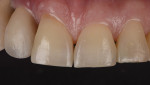 Fig 12. Conservative
restoration of the incisal edges, diastema, and cervical defects using Venus Diamond PURE, Medium shade.