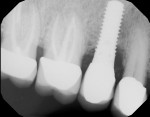 Fig 1. Preoperative radiograph of implant No. 4 with peri-implantitis upon presentation in January 2015. The implant
was not mobile, but bone loss was evident to the third thread on the mesial aspect.