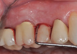 Fig 2. Pretreatment clinical view.
Probing depths around implant No. 4 were 7 mm, 7 mm, and 9 mm buccally, from distal to mesial, and 9 mm, 7 mm,
and 7 mm lingually, from mesial to distal. Heavy bleeding occurred circumferentially upon probing. No visible facial
recession was observed.