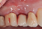 Fig 3. Immediate post-treatment in 2015. The LAPIP procedure was completed for implant
No. 4 and the laser-assisted regeneration procedure was performed on adjacent teeth Nos. 2, 3, and 5. A total of 542
joules of laser energy was administered via insertion of an optical fiber into the sulcus in the maxillary right sextant.
Following the treatment, discussion with the patient included re-evaluation in 6 months for soft- and hard-tissue
healing and determination of whether there would be a subsequent need to re-enter the area surgically for a guided
bone regeneration procedure. No surgical re-entry would be needed for this patient, because clinical healing was
evident with significant pocket depth reduction and elimination of BOP. A maxillary nightguard appliance was recommended
to control the patient’s parafunctional habits.