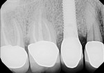 Fig 4. In 2016 (1.5 years postoperative),
radiograph showed
significant bone fill had occurred
over the preceding 17 months.
Clinically, probing depths were
significantly decreased. No
bleeding or suppuration were
noted during postoperative
examinations.