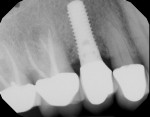 Fig 6
and Fig 7. Post-treatment digital
radiography at 7 years showed
increased bone density and
complete fill on the mesial and
distal aspects of implant No. 4.