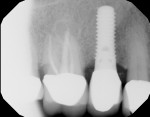 Fig 6
and Fig 7. Post-treatment digital
radiography at 7 years showed
increased bone density and
complete fill on the mesial and
distal aspects of implant No. 4.