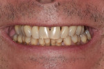 Fig 1. Preoperative patient smile. The patient had severe periodontitis, stage III, grade B. His primary concern was that
despite recently having full-mouth periodontal surgery he was still experiencing discomfort eating and chewing food
with teeth that had significant mobility. Based on the clinician’s examination and diagnosis, a full-arch fixed prosthesis
was deemed the ideal treatment for the patient.