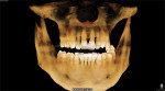 Fig 3. Preoperative CBCT. The digital
workflow begins with recording accurate records at the time of the examination. These include full-mouth intraoral scans,
CBCT imaging, correct occlusal bite, intraoral photographs, and detailed medical history.