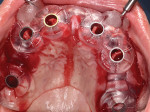 Fig 5. Occlusal view of implant guide.