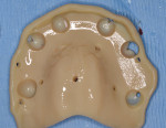 Fig 9. Based on the initial smile design, a temporary
prosthesis is used to aid in acquiring an accurate bite registration. A
third scan is of the intaglio and occlusal surface of this denture (as
shown). STL files are then transferred to the laboratory technician to
finalize the design of the temporary prosthesis using exocad software.
The temporary prosthesis is then 3D-printed (SprintRay) and ready to
be delivered in the patient’s mouth less than 90 minutes after surgery.