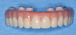 Fig 10. Final prosthesis. With the Nobel Biocare N1 system protocol, the
patient was ready for his final prosthesis 6 to 8 weeks after implant
placement. Because the temporary prosthesis was fabricated based on
the ideal positioning of the implants, only slight change was expected
in terms of hard-tissue remodeling and soft-tissue shrinkage and
healing.