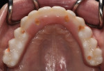 Fig 12. Occlusal
view of final prosthesis.