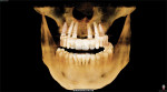 Fig 14. CBCT scan at
3-month postoperative follow-up showing radiographically the implant
placement and temporization.