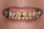 Fig 1. Preoperative view. The patient’s smile was misaligned and damaged. A smile study was conducted to ensure
optimal esthetic results.