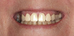 Fig 3.
The smile design fit was compared digitally to the patient’s smile for proper fit.