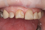 Fig 7. Severe wear of the enamel required restorative treatment. Teeth Nos. 7 through 10 were prepared by removing
broken, decayed, and decalcified enamel. Healthy enamel was left in place.