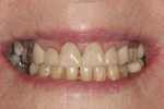 Fig 10. The patient’s dental health and function were fully restored while appealing esthetics
and a more youthful smile were created.