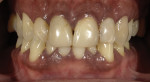 Fig 1. Preoperative, retracted
view at presentation.