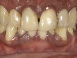 Fig 2.
Preoperative, close-up view
of maxillary lateral and central
incisors.