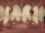 Fig 9. Removal of old
composite material and
creation of beveled starburst
margin preparation.