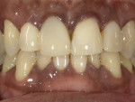 Fig 10.
Final restorations with Beautifil
Flow Plus X after polishing,
using diamond spiral polishers
and the Super-Snap® disc
system (Shofu) for final
polishing and contouring.