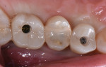 Fig 1. Screw-holes in screw-retained implant crowns, Nos. 3 and 5.