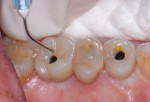 Fig 3. To begin the treatment sequence of sealing the
space and concealing the screw-hole, porcelain etchant was placed for 60 seconds after the margins were roughened
using a rough football diamond bur.