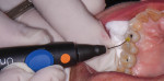 Fig 5. The outer margins and inner canal were coated with a universal adhesive (Adhese® Universal, Ivoclar).