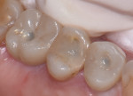 Fig 9. It is imperative to use only 0.5 mm to 1 mm
of OMNICHROMA BLOCKER, as shown, and to leave maximum space for OMNICHROMA composite.