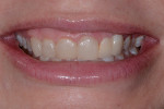 Fig 2. Preoperative close-up view of the
patient’s smile. Note the asymmetry between the central incisors, dark shade, and over-contoured restorations. The
patient had an asymmetric smile with the upper lip being higher on the right side and the gingiva appearing excessive
and asymmetric.