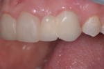 Fig 3. The pontic was on top of the tissue rather than appearing as emerging from the tissue. The
connector between the lateral incisor and canine was long and provided no room for the papilla.