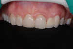 Fig 4. After a smile
design evaluation, gingival sculpting was performed with the Gemini EVO Laser to improve gingival symmetry. Based on
available free gingiva and biologic width considerations, 1.5 mm of gingiva was removed from the maxillary right canine,
right lateral, and right central, and 1 mm of gingiva was removed from the left central. This made the height of the
gingiva on the canines and centrals approximately equal and the height of the gingiva of the laterals 0.5 mm lower than
the height of the centrals and canines. The gingival zenith was now positioned just distal to the midline on the canines
and centrals, and on the midline on the lateral.