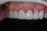 Fig 5. To develop the left lateral incisor pontic site, a split-thickness
crescent-shaped incision was made with the Gemini EVO Laser, and the tissue was folded under. A two-unit cantilever
provisional bridge was fabricated from a provisional composite (Inspire™, Clinician’s Choice) and finished with a provisional
resin glaze (Glisten™, Clinician’s Choice), with the tissue side of the pontic being convex and holding the folded
tissue in place for healing. This will heal with a concavity to give the final pontic the appearance of emerging from the
tissue rather than sitting on top of it. Provisionals were also fabricated for the maxillary right canine, right lateral incisor,
right central incisor, and left central incisor and cemented with temporary veneer cement (ClearTemp™ LC, Ultradent).