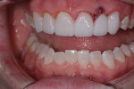 Fig 6. At 4 days postoperative from the gingival sculpting
and pontic site development surgery, healing of the
gingiva was evident on the right canine, right lateral
incisor, right central incisor, and left central incisor. The
pontic site, although still inflamed, was beginning to
nestle around the provisional pontic.