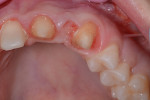 Fig 9. Occlusal view
of the pontic site.