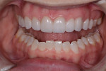 Fig 10. Layered lithium-disilicate
veneers (e.max®, Ivoclar) were used for the maxillary
right canine, right lateral incisor, and right central incisor,
and a layered lithium-disilicate crown (e.max) for the
maxillary left central incisor. A layered lithium-disilicate
bridge (e.max) was fabricated for the maxillary left
lateral incisor and left canine. The veneers were cemented
with PANAVIA™ Veneer LC (Kuraray). The bridge was
cemented with PANAVIA™ V5 (Kuraray).