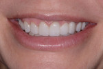 Fig 11. Postoperative
close-up view of the patient’s smile, demonstrating
improved harmony with symmetric gingival show, a
natural pontic emergence on the bridge, and proportional
teeth.