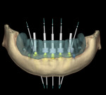 Fig 1. Digital treatment plan for an edentulous mandibular All-on-5
treatment for a 50-year-old male patient.