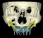 Fig 2. A “quad” zygoma
digital treatment plan for treatment of severe maxillary atrophy in a
68-year-old male patient.