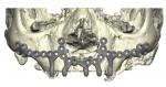 Fig 3. Full-arch, non-endosseous implant
digital treatment plan for severe maxillary atrophy in a 69-year-old
male patient.