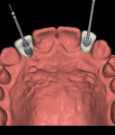 Fig 4. Digital treatment plan with virtual teeth for a
20-year-old female patient with congenitally missing teeth Nos. 7 and
10. Note the limited spacing available.