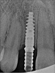 Fig 5. Postoperative periapical radiograph of implant No. 7 in the 20-year-old patient in Fig 4.