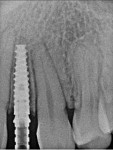 Fig 6. Postoperative periapical radiograph of implant No. 10 in the 20-year-old patient in Fig 4.