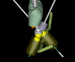 Fig 7. Digital treatment plan with virtual
teeth for a 65-year-old female patient. Note implant angulations corrected
with 30-degree multi-unit abutments.