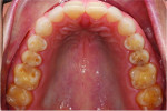 (3.) Pretreatment occlusal views of the maxillary and mandibular arches, respectively, showing erosive tooth wear.