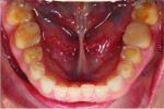 Pretreatment occlusal views of the maxillary and mandibular arches, respectively, showing erosive tooth wear.